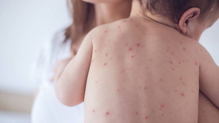 Salud confirma 20 casos de sarampión en Santa Cruz y refuerza la vacunación preventiva
