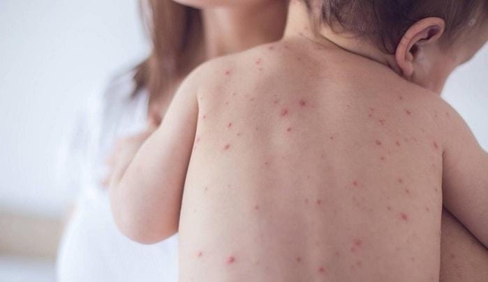 Ministerio de Salud recomienda 11 medidas para cuidar a una persona con Sarampión